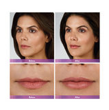 Juvederm Volbella XC
