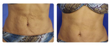 SkinTyte Laser Skin Tightening