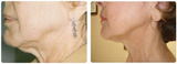 SkinTyte Laser Skin Tightening