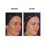SkinPen Microneedling