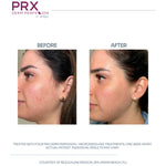PRX Derm Perfexion