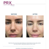 PRX Derm Perfexion