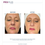 PRX Plus