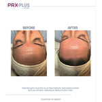 PRX Plus