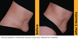 Ultherapy Prime