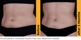 Ultherapy Prime