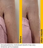 Ultherapy Prime