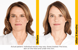 Ultherapy Prime