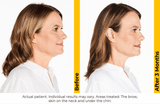 Ultherapy Prime