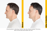 Ultherapy Prime