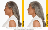 Ultherapy Prime